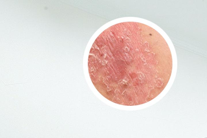石家庄治疗腿部银屑病