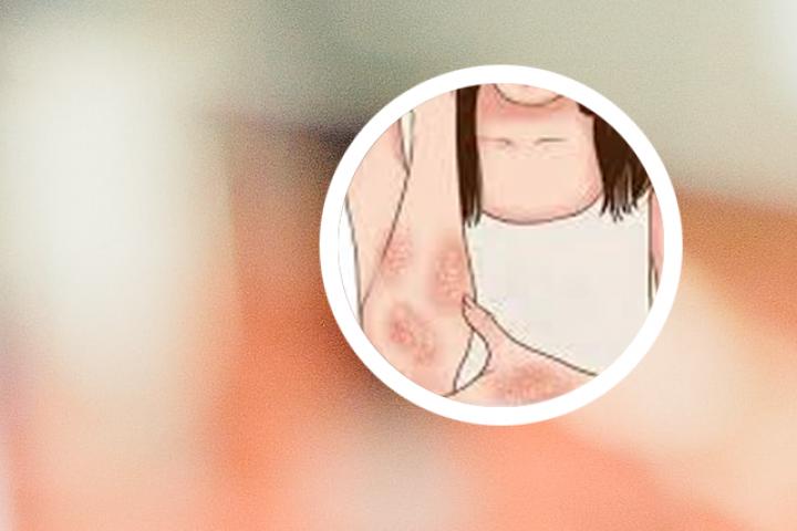 搽药后银屑病皮损为什么会变白
