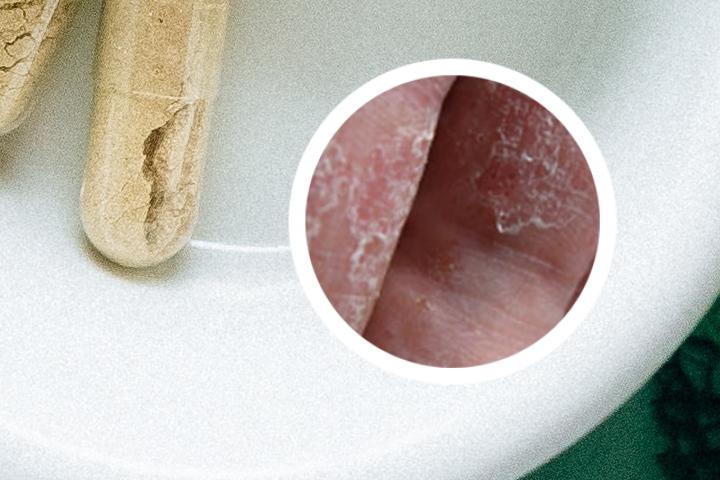 我用偏方治好了银屑病