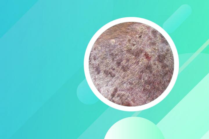寻常型银屑病起因