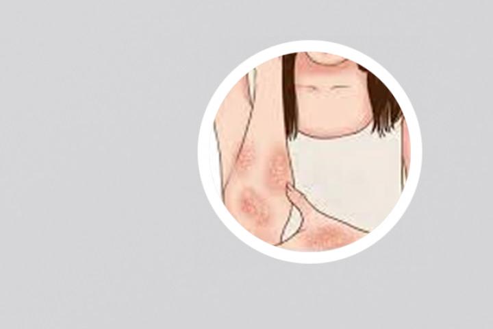 银屑病反复爆发