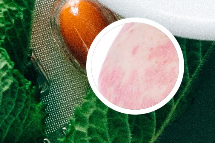 银屑病老年加重吗