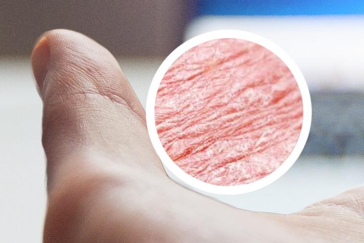 儿童银屑病可以完全治愈吗
