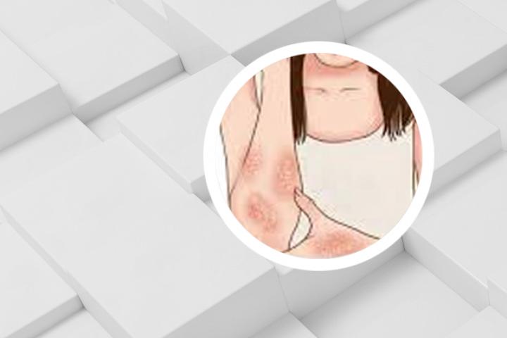 八一医院能治牛皮癣吗