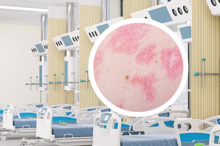宜昌有没有中医偏方能治疗银屑病