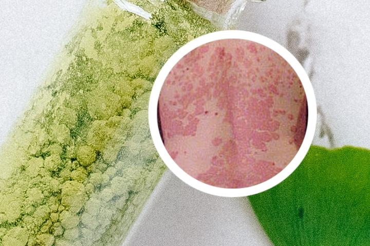 宁波牛皮癣治理