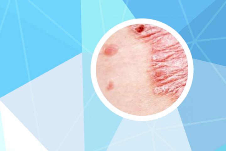 银屑病患者可以染发吗