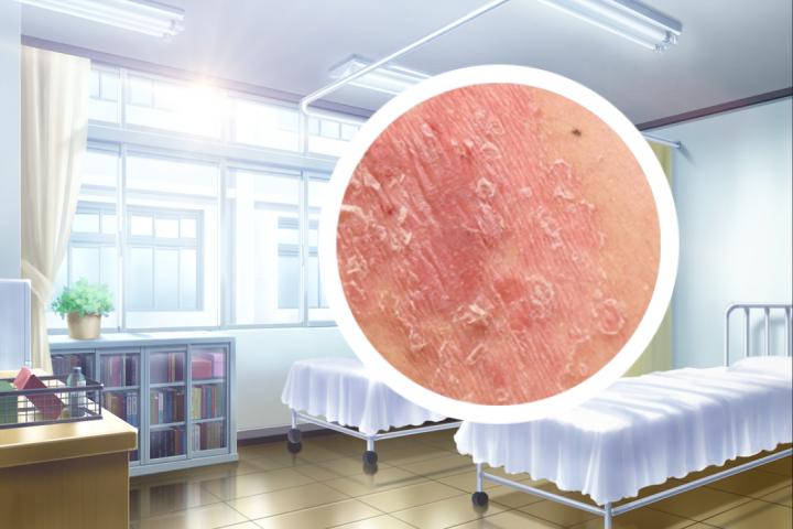 掌趾角化银屑病