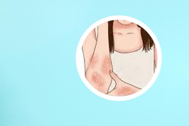 不是所有银屑病都复发