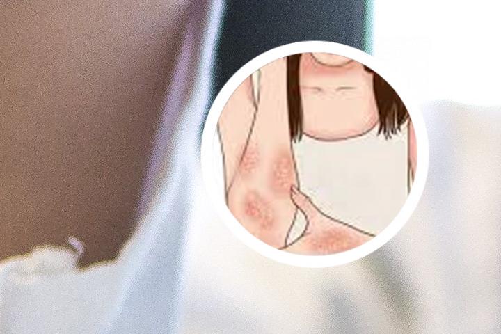 小孩银屑病怎么治疗快