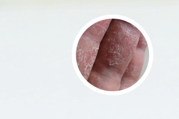 银屑病晚上几点睡觉最好