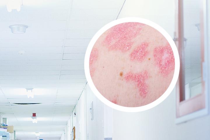 银屑病用抑菌乳膏能不能好
