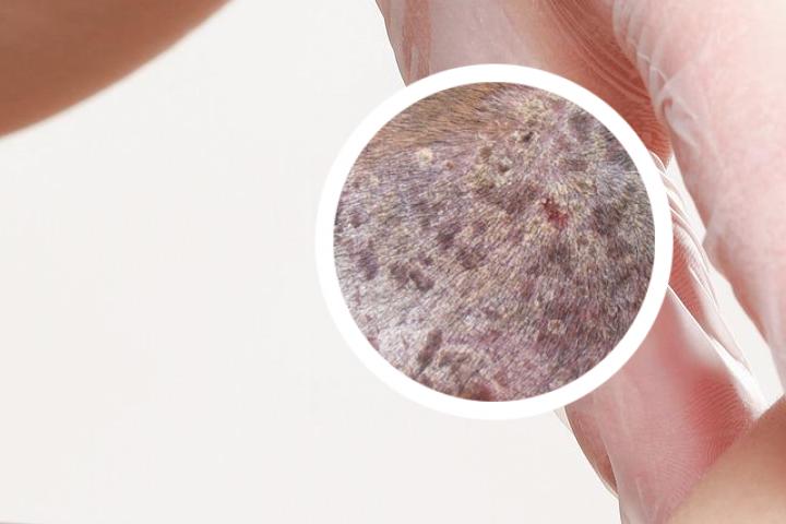牛皮癣关节小腿头皮发病
