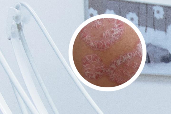 寻常型银屑病能治好吗