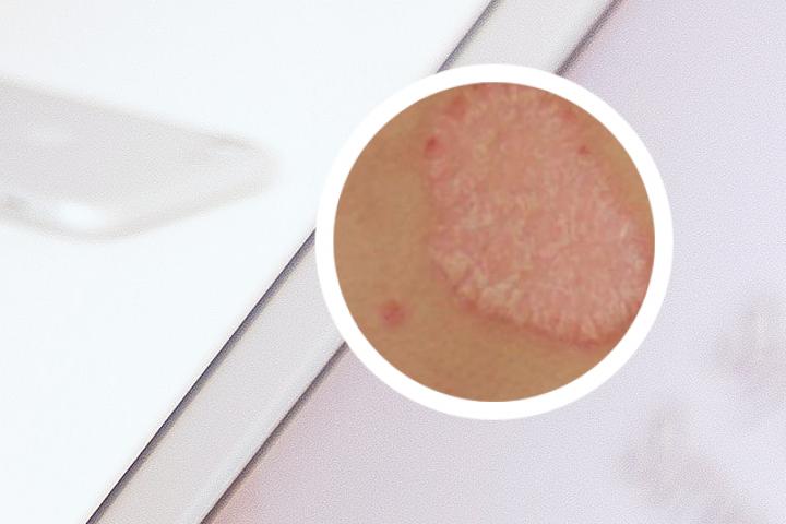 银屑病可以打HPV