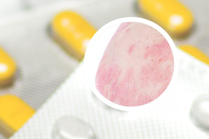 银屑病性关节炎用强克