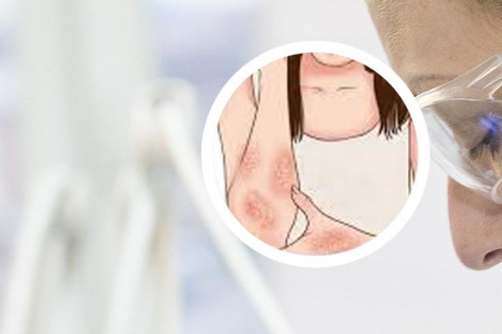氨肽素治疗银屑病怎样