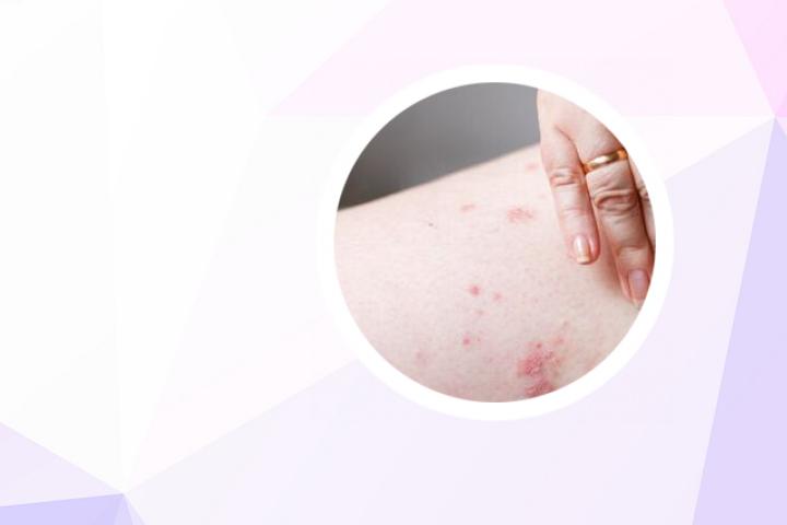 女性银屑病治疗