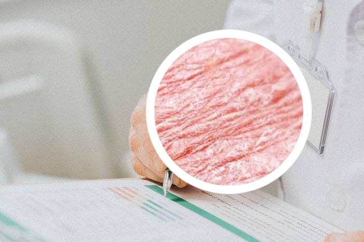 银屑病bsa评分
