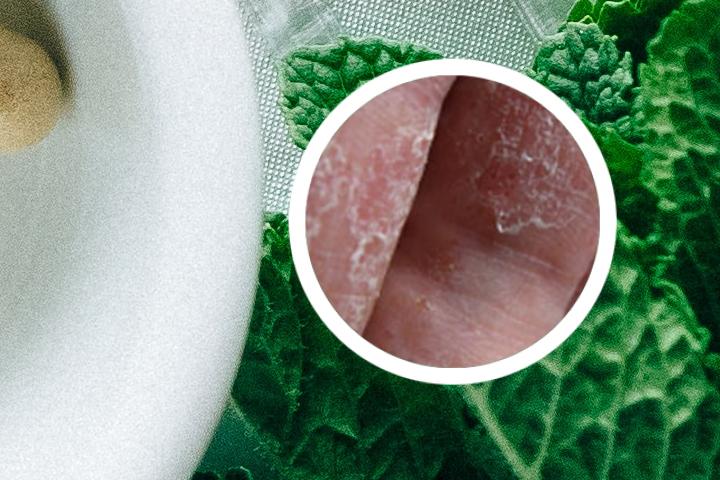 得了牛皮癣不能结婚么