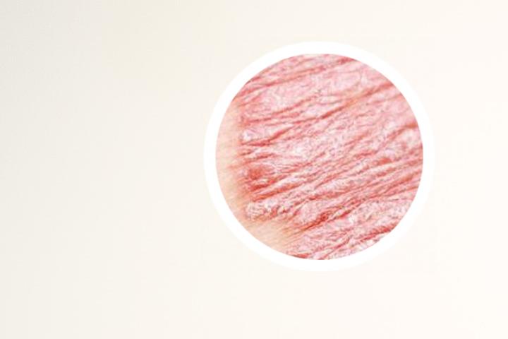 银屑病需要查结核吗