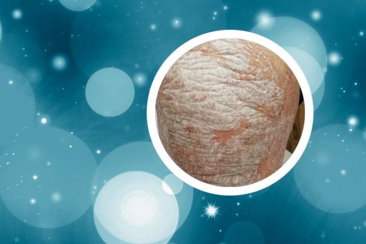 如何使用中药秘方治疗银屑病