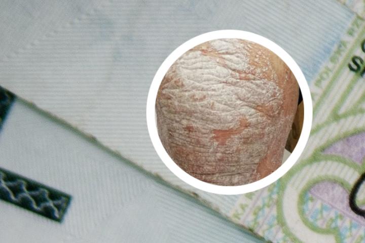 银屑病pasi评分多少分是重度
