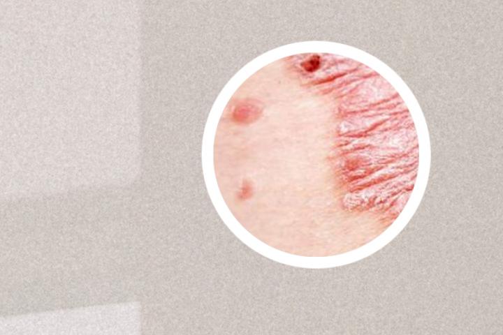 银屑病能否通过施伟民的视频治愈呢