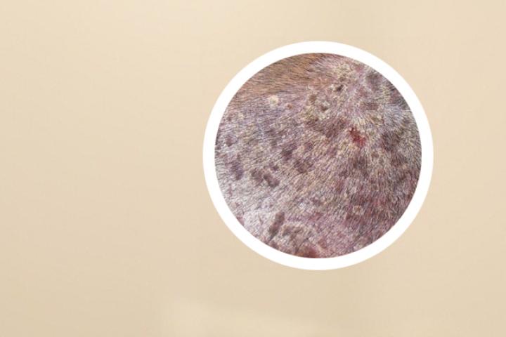 白介素抑制剂治疗银屑病