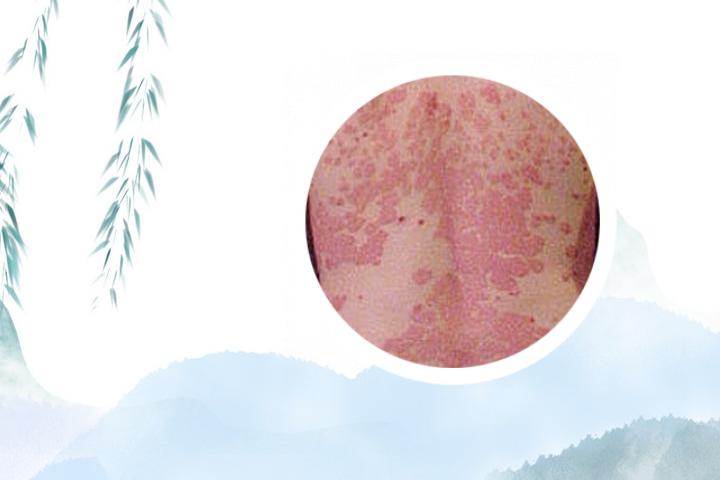 为什么银屑病是毒
