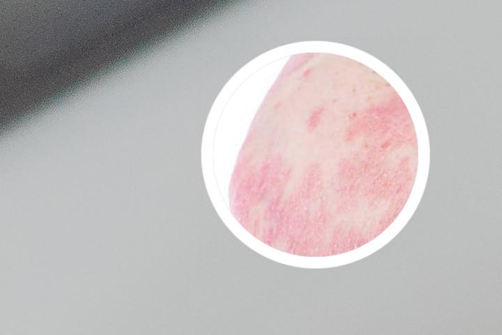 银屑病几种生物制剂