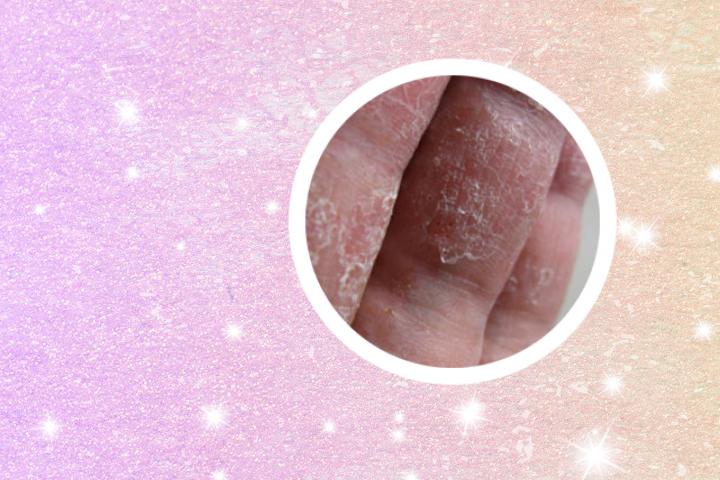 头上长银屑病用什么药最好