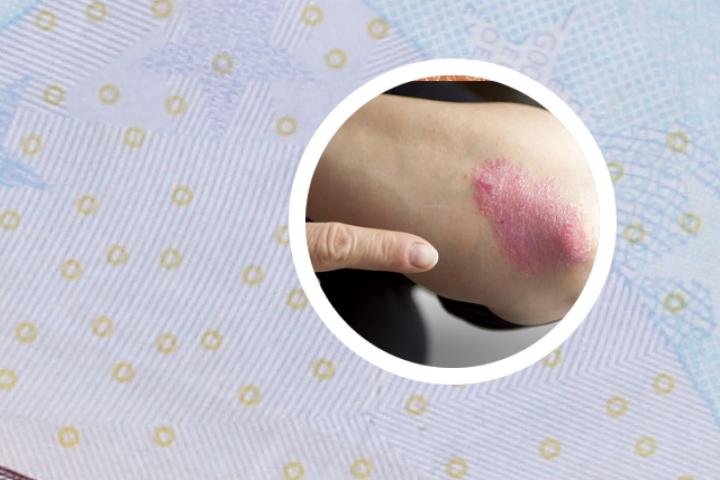 请问龙岩哪家医院治疗小孩银屑病效果好