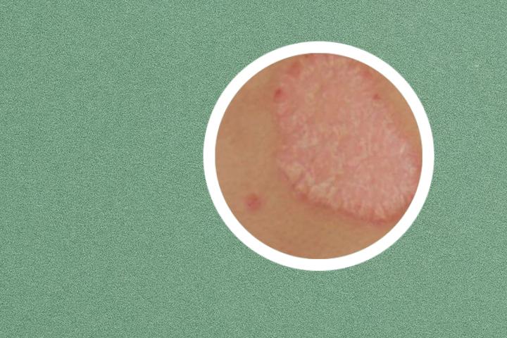 氧化锌银屑病可以用吗