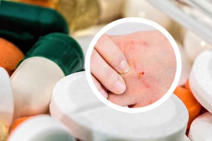 银屑病患者适合泡澡还是淋浴