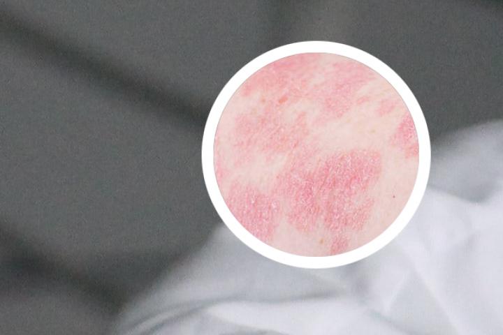治牛皮癣的360