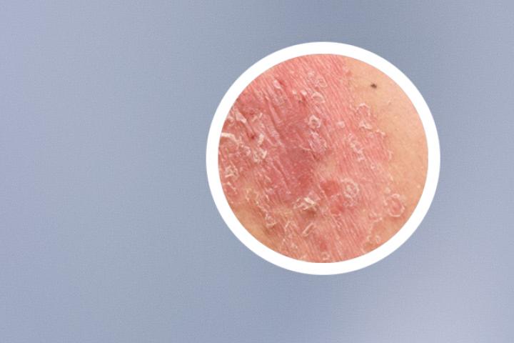 阿维a胶囊治银屑病的效果怎么样