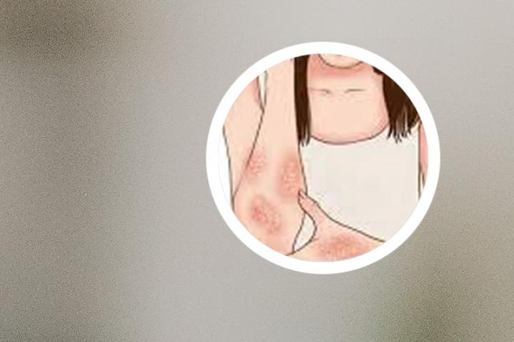 银屑病能熬夜吗