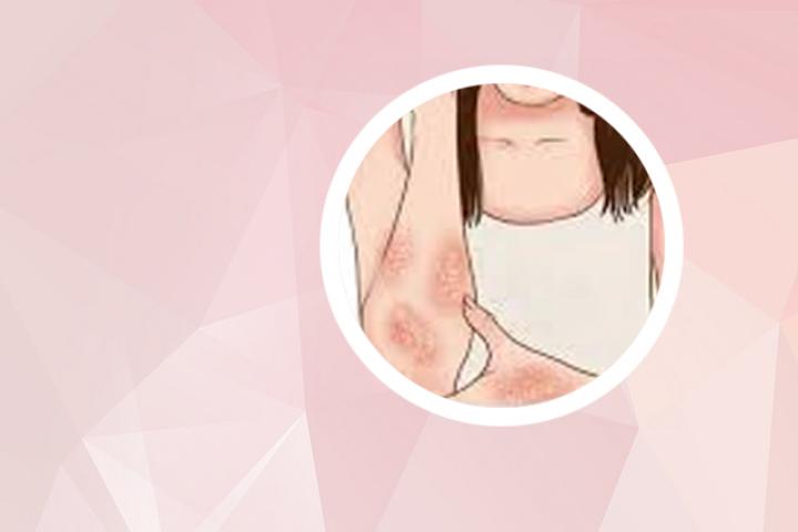 银屑病是什么引起的