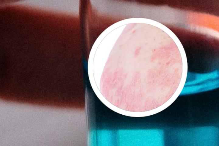 银屑病生物制剂弊端
