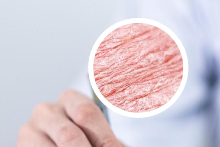 牛皮癣特效药膏断根