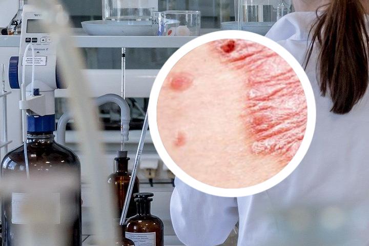 银屑病为何在男子身上恶化