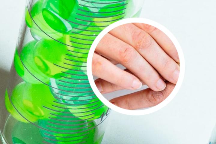 疱疹性银屑病偏方