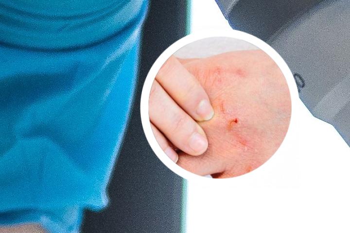 银屑病吃阿维A效果不明显咋回事