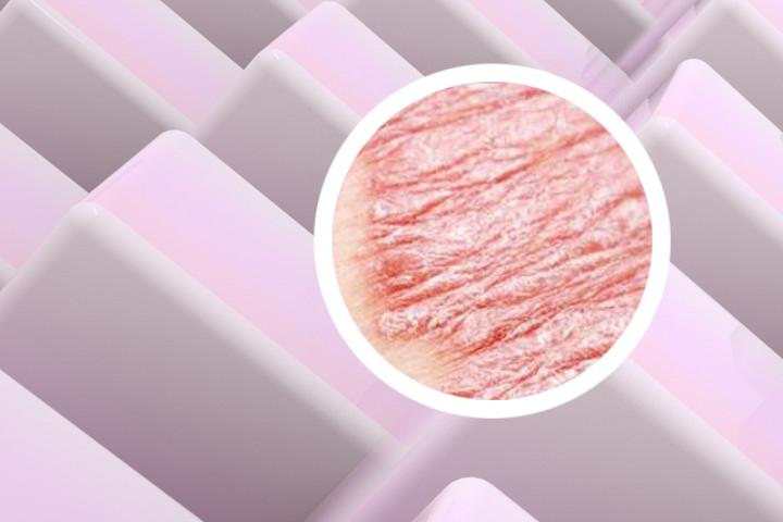 父母亲戚都有牛皮癣