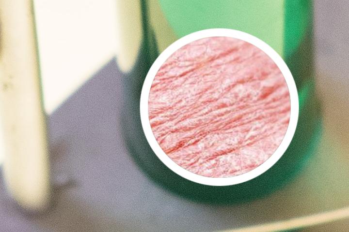 银屑病遇醋