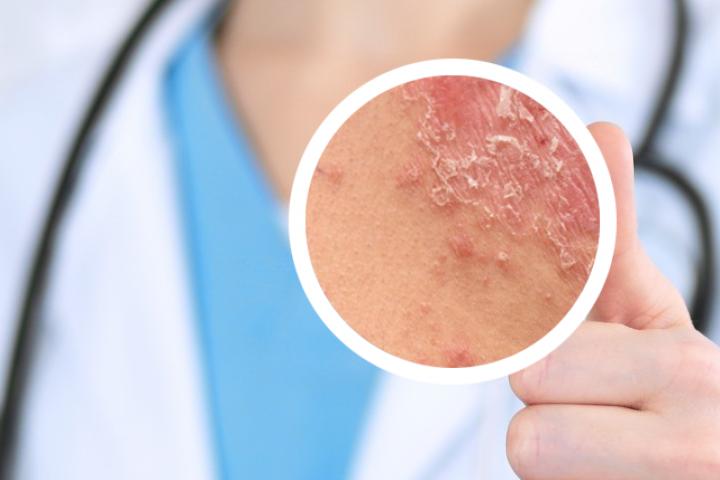 白疕软膏治疗银屑病吗 银屑病是什么引起的