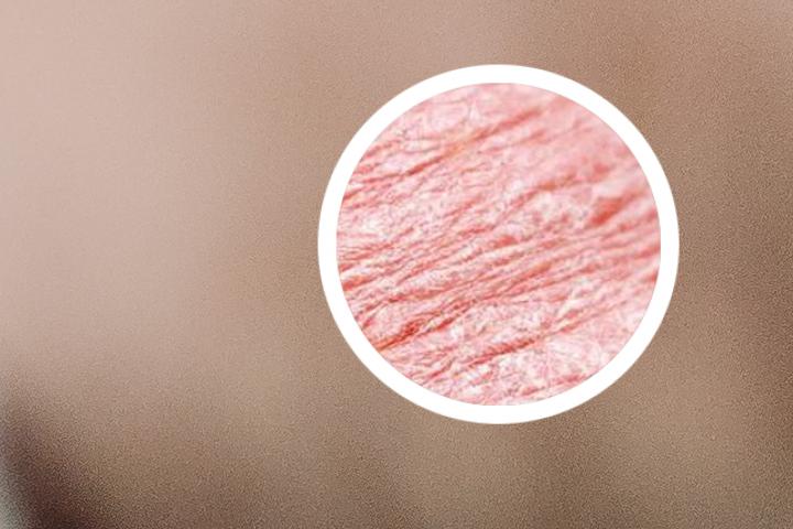 银屑病会传染给孩子吗