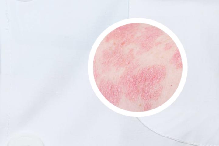 银屑病的血常规指标
