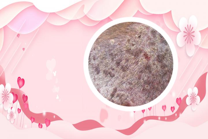 打疫苗会对银屑病患者有什么影响吗